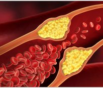 Холестерин: Розуміння різниці між добрим та поганим холестерином